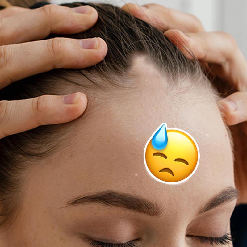 Alopecia femenina. Todo lo que debes saber.