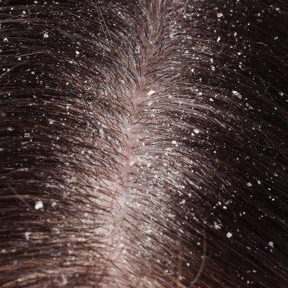 ¡Adiós a la nieve de tu cabeza!